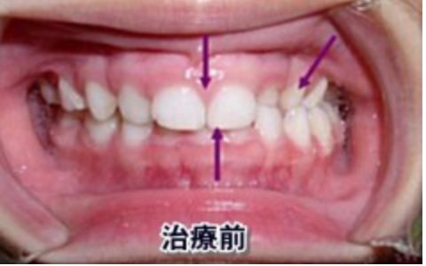 交差咬合の治療例：お子さん治療前