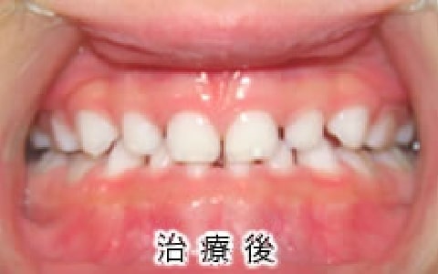 受け口の治療例：お子さん治療後