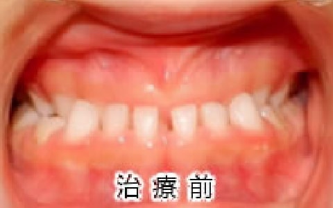 受け口の治療例：お子さん治療前