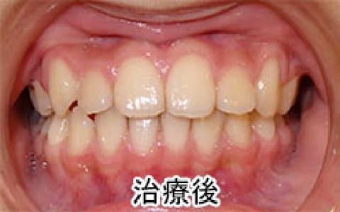 反対咬合、乱杭歯の治療例：お子さん治療後