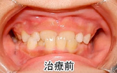反対咬合、乱杭歯の治療例：お子さん治療前