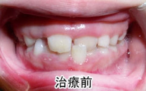 外傷性咬合の治療例：お子さん治療前