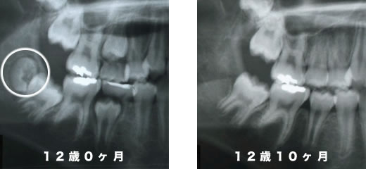 症例