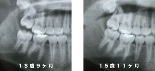 症例